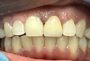 The image shows a close-up of a person s teeth with yellow staining, emphasizing dental hygiene or the need for teeth whitening.