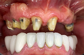 Smile Dental JC | Cosmetic Dentistry, Air Abrasion and Dentures